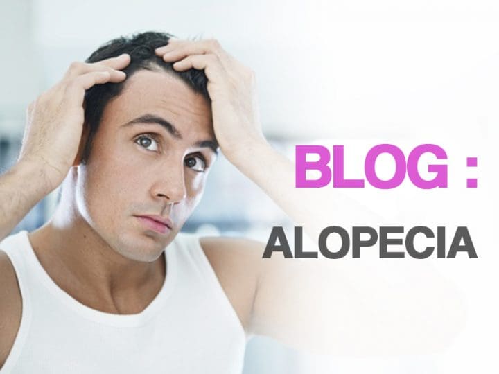 Alopecias; Tipos y tratamientos
